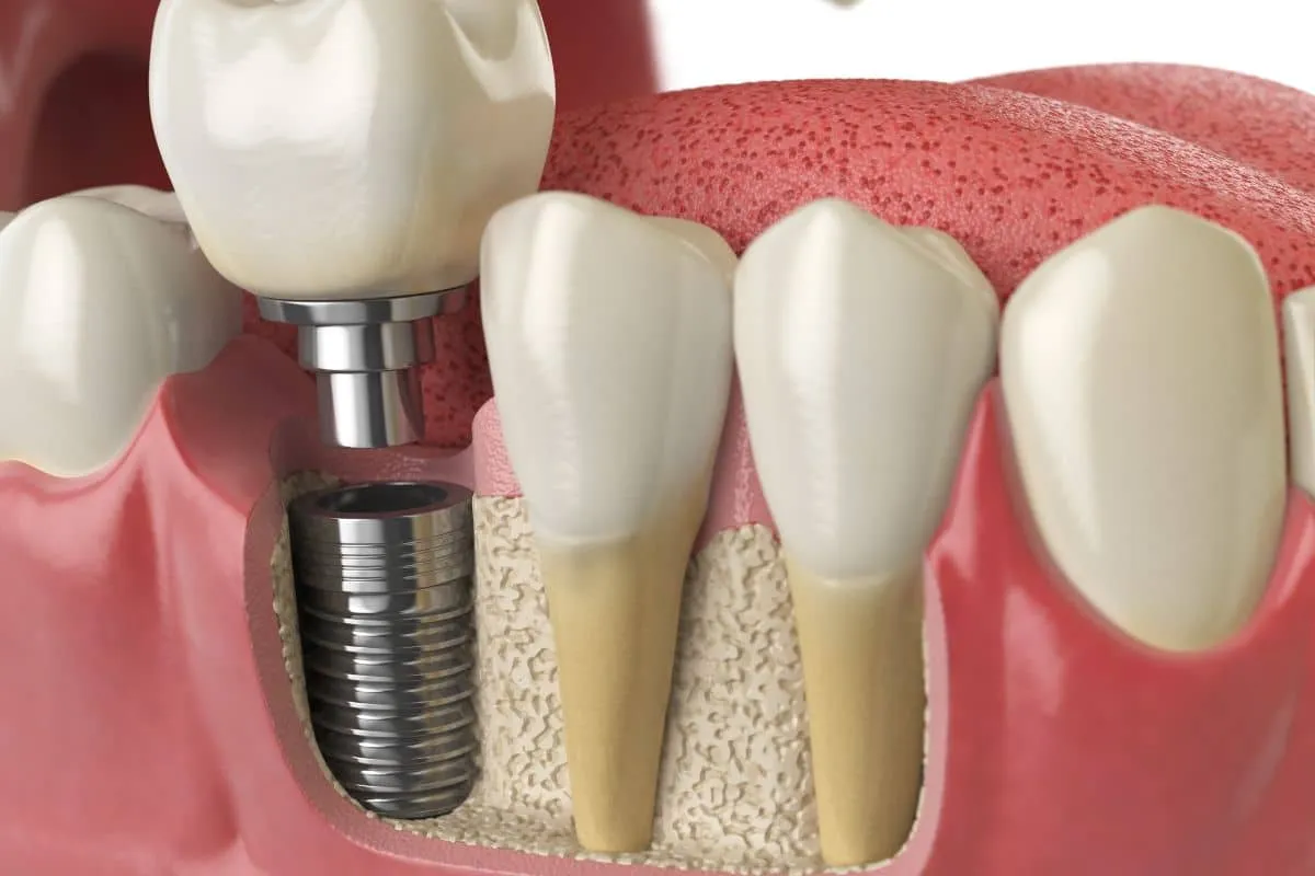 Warning Signs of Dental Implant